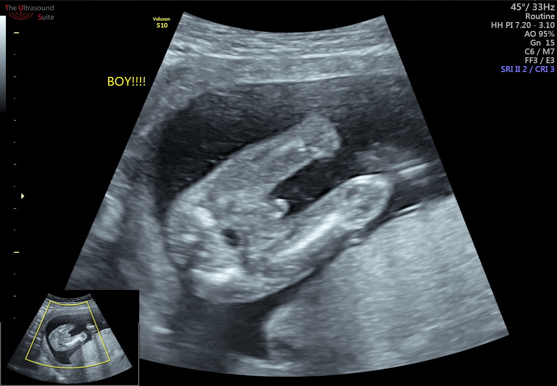 fetal gender assignment by first trimester ultrasound