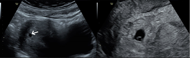 Early Pregnancy Scan What To Expect The Ultrasound Suitethe