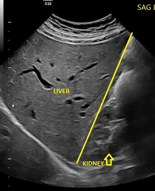 Normal Liver Ultrasound normal-liver-ultrasound