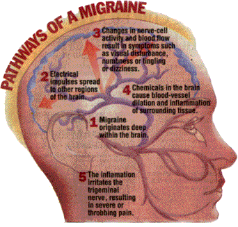 What Are Menstrual Migraines and How Can They Be Managed? - The Ultrasound  SuiteThe Ultrasound Suite