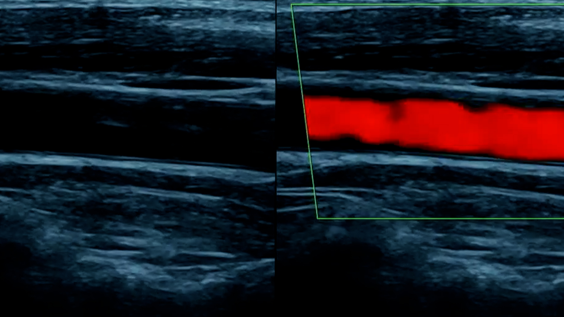 Carotid Artery Ultrasound - The Ultrasound Suite